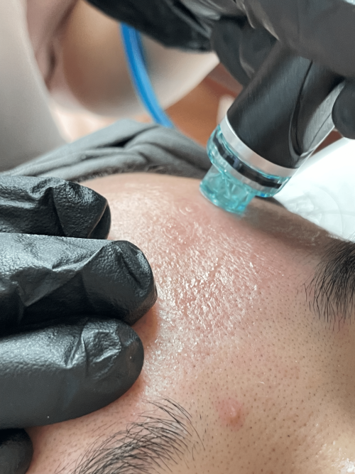 close up of aesthetician performing hydrafacial on patient's forehead